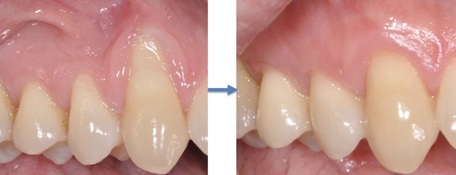 Greffe de gencive et procédure gingivale esthétique Spécialistes Dentaires et Implantologie du