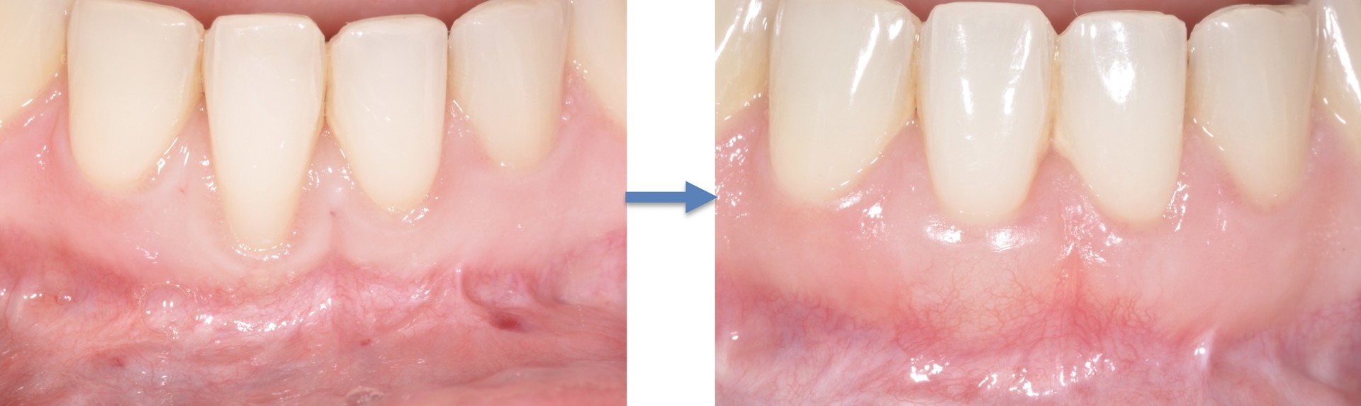 Greffe de gencive et procédure gingivale esthétique Spécialistes Dentaires et Implantologie du