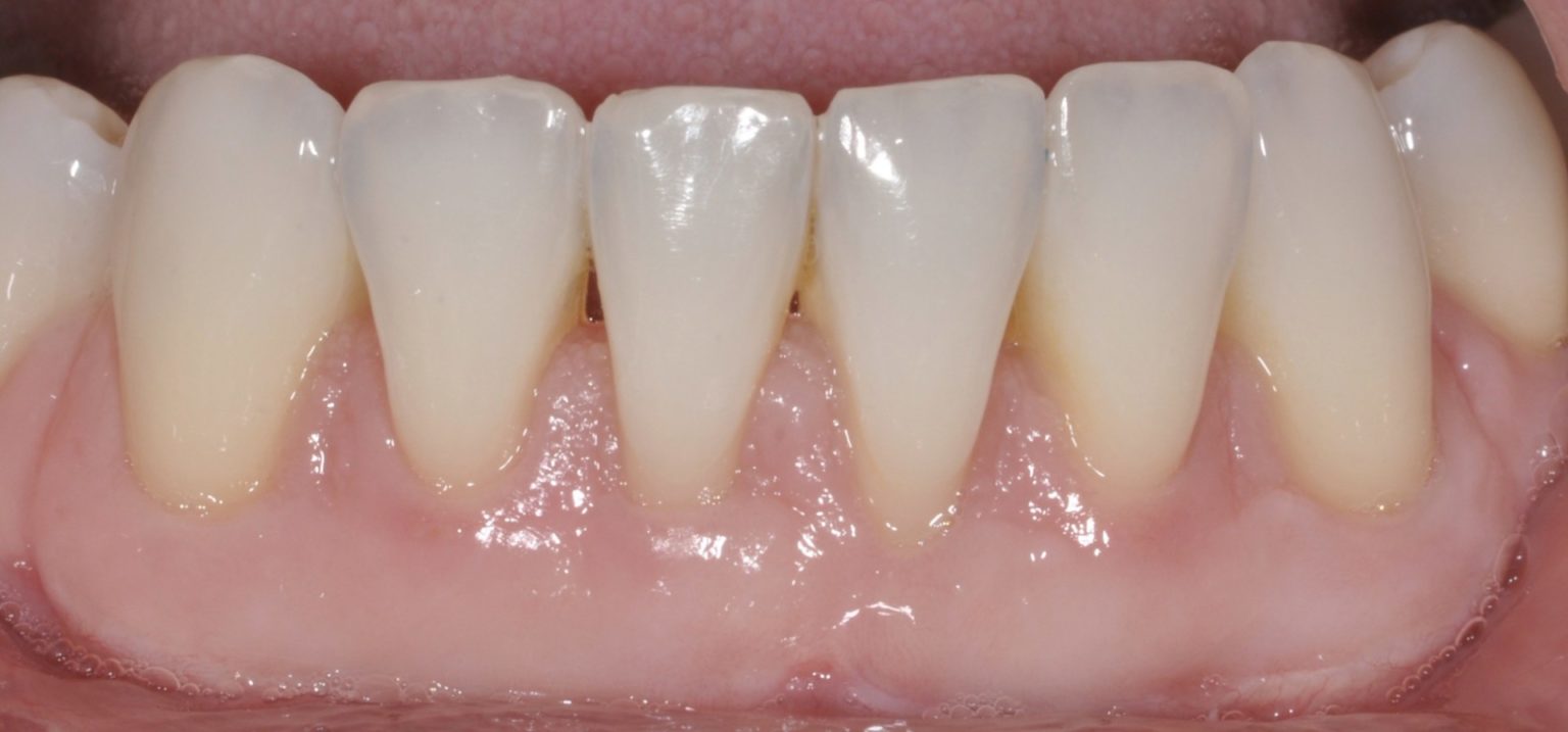 Greffe de gencive et procédure gingivale esthétique Spécialistes Dentaires et Implantologie du
